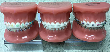 3M Clarity Braces