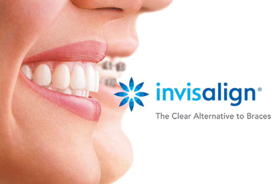 Invisalign® Clear Aligners